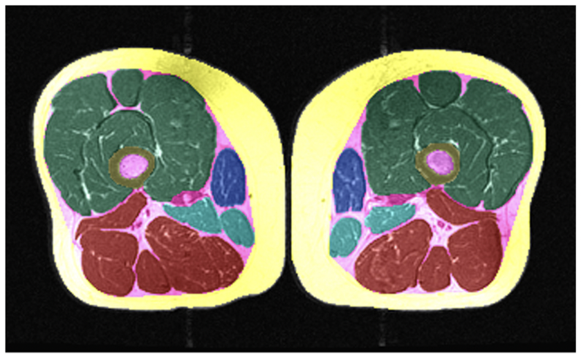 Clinical validation of fully automated segmentation of thigh muscle and adipose tissue cross sectional areas using maching learning with a convolutional neural network
